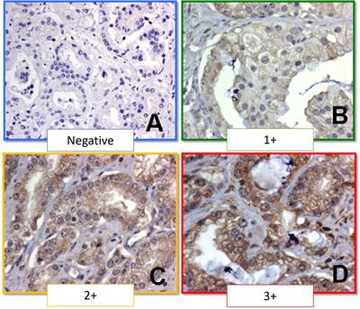 Differences in the expression of the phosphatase PTP-1B in patients with localized prostate cancer with and without adverse pathological features